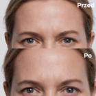 silikonowe plastry przeciwzmarszczkowe – wygładzenie już po pierwszym użyciu silikonowe plastry przeciwzmarszczkowe – wygładzenie już po pierwszym użyciu